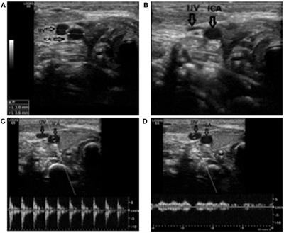 Supraclavicular Approach to Ultrasound-Guided Brachiocephalic Vein Cannulation in Children and Neonates